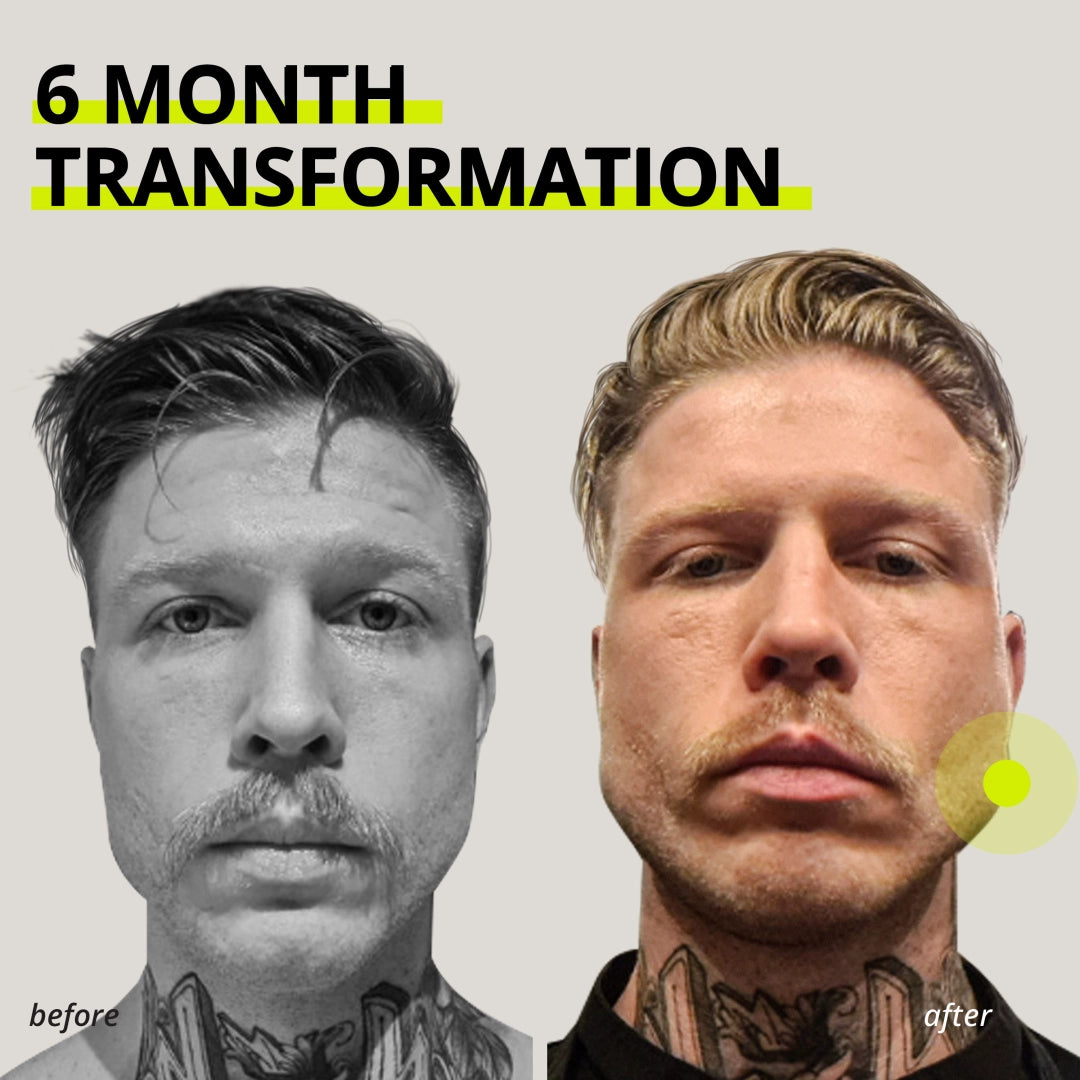 Chicle entrenador de mandíbula Jawliner®