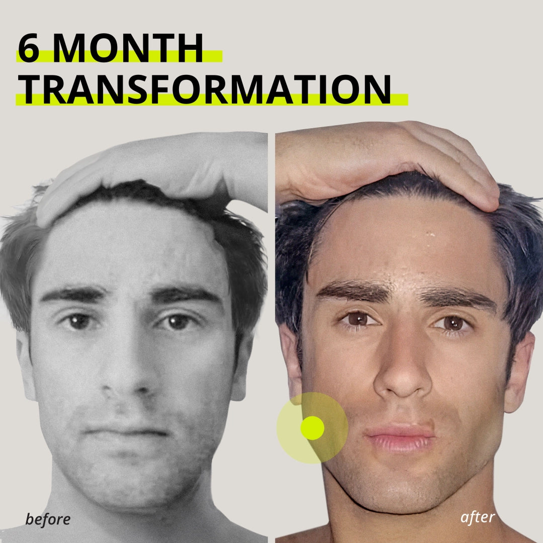 Chicle entrenador de mandíbula Jawliner®