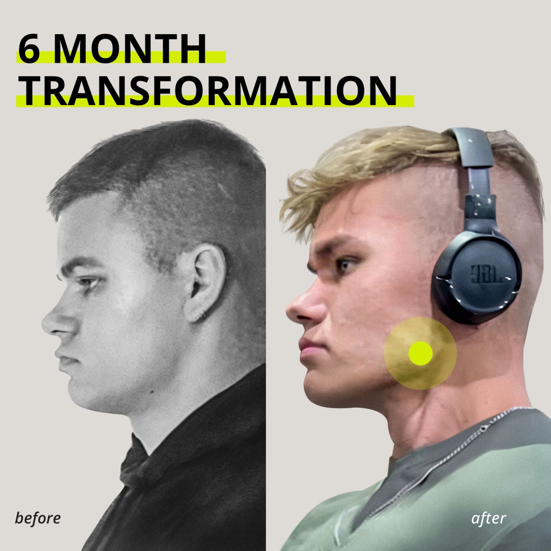 Chicle entrenador de mandíbula Jawliner®